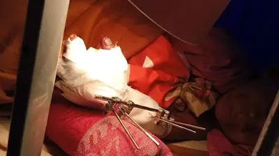 Korban petasan bocah berusia 6 tahun berinisial OSA di Kalurahan Argodadi, Kapanewon Sedayu, Bantul .